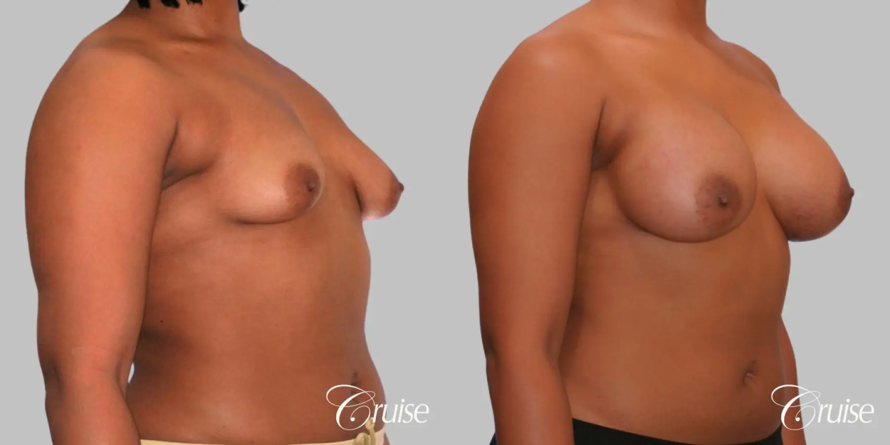 Breast Augmentation - Silicone HP 450cc - Before and After 2