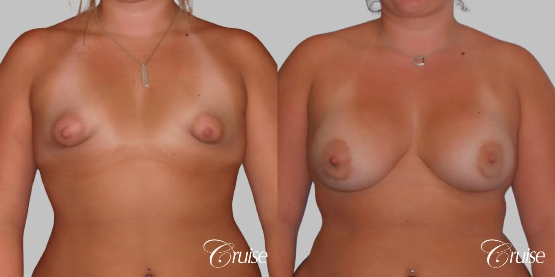 Breast Augmentation - Silicone HP 450cc - Before and After 1