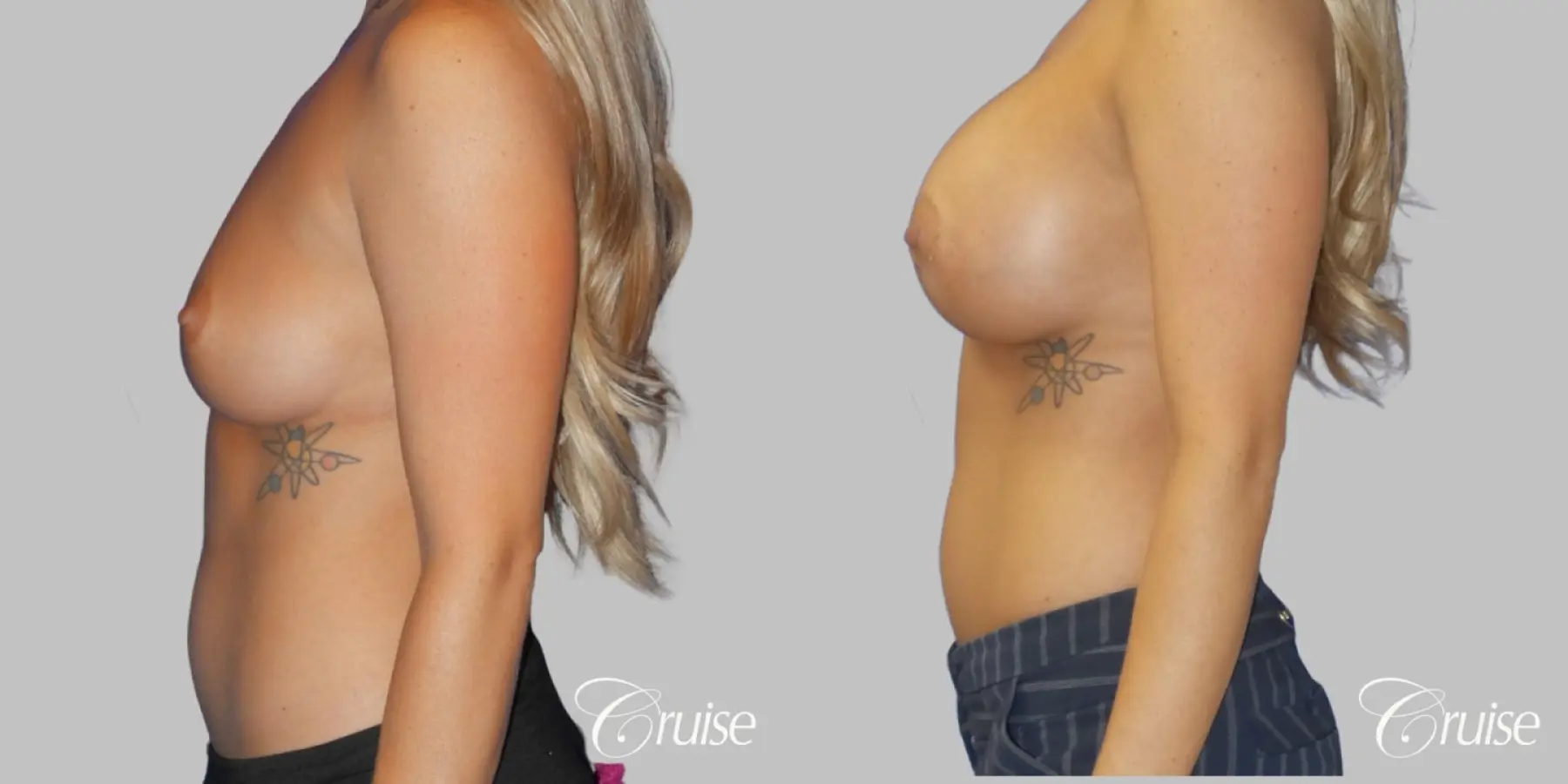 Breast Augmentation - Silicone HP 475cc - Before and After 4