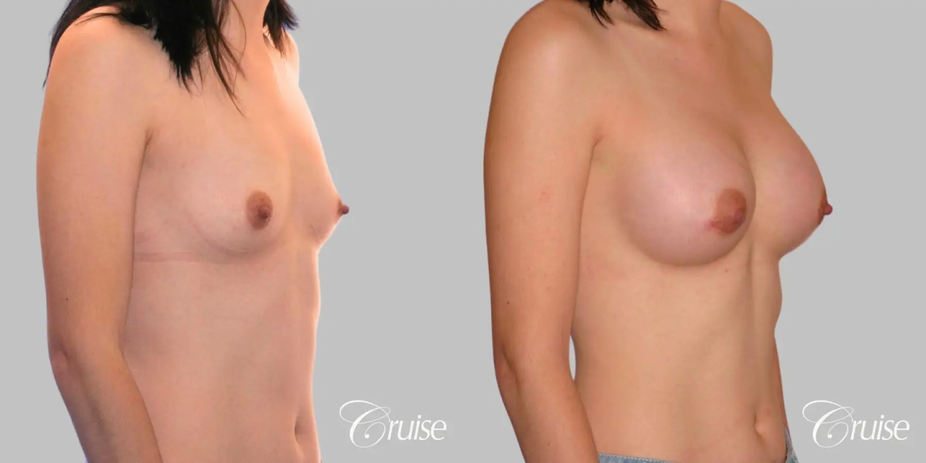 Breast Augmentation - Silicone MP 304cc - Before and After 3