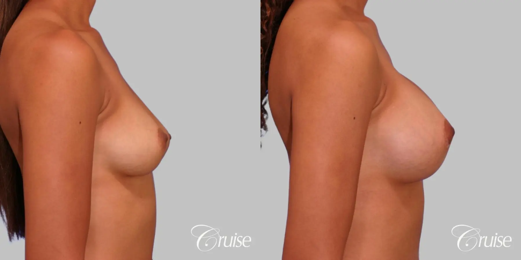 Breast Augmentation - Saline MP 375cc - Before and After 3