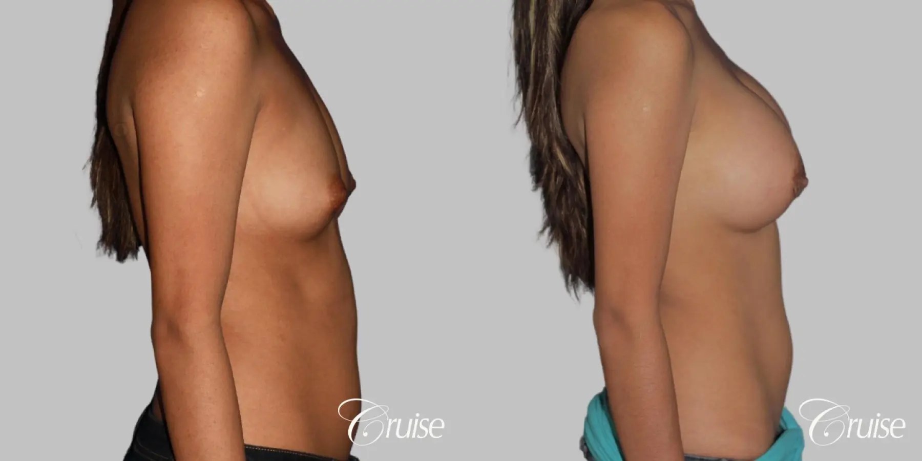 Breast Augmentation - Silicone MP 339cc - Before and After 4