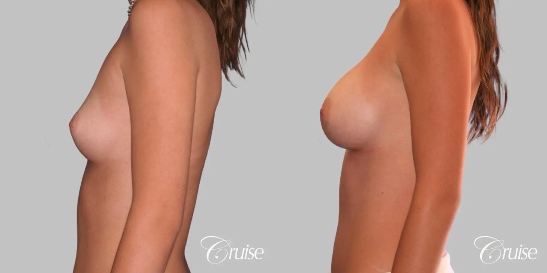 Breast Augmentation - Saline MP 360cc - Before and After 2