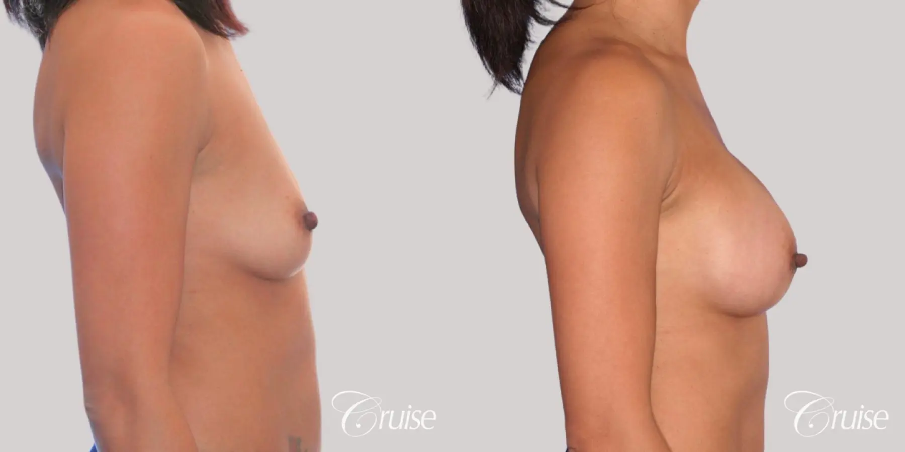 Breast Augmentation - Saline MP 255cc - Before and After 3