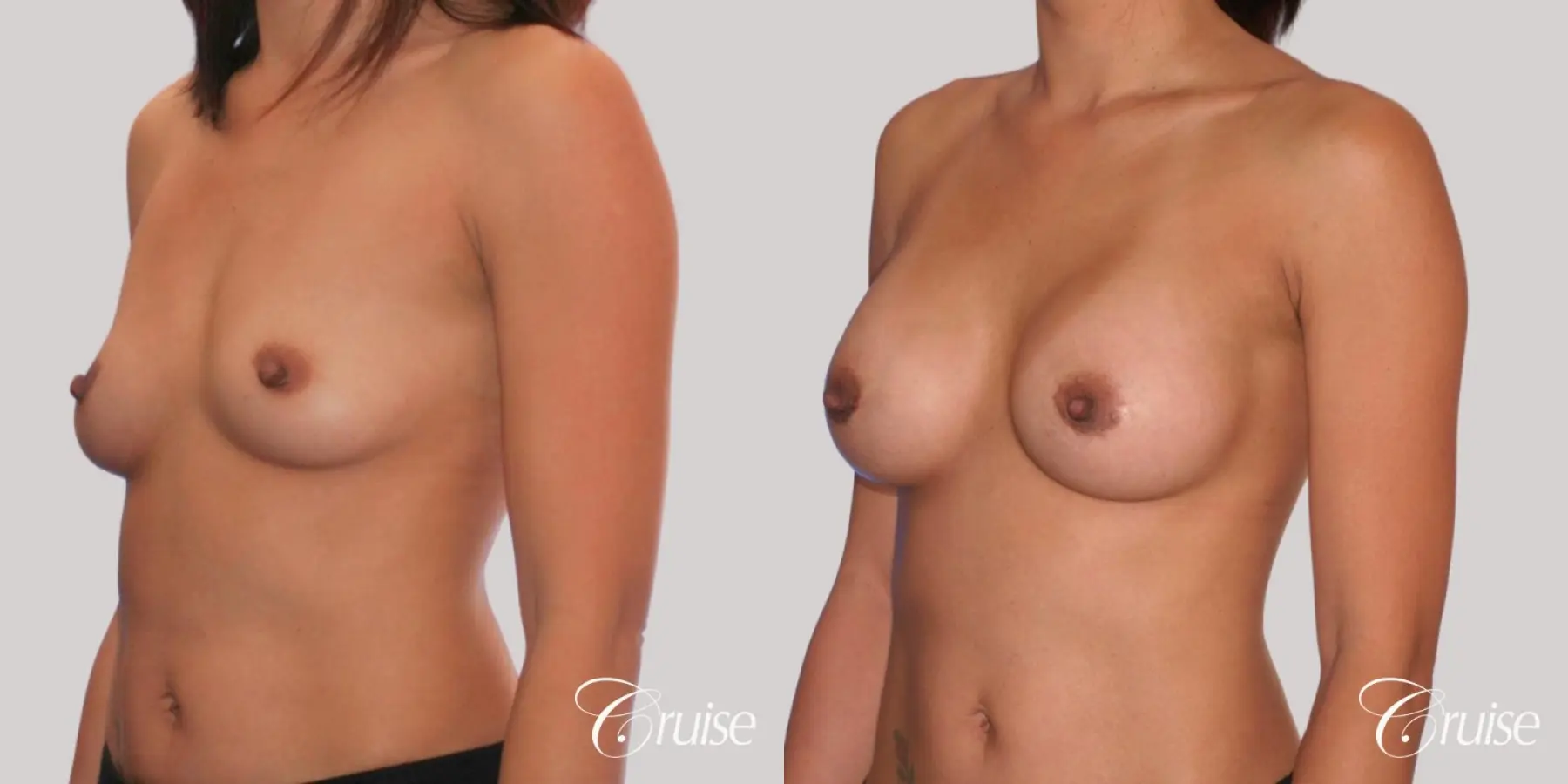 Breast Augmentation - Saline MP 255cc - Before and After 4