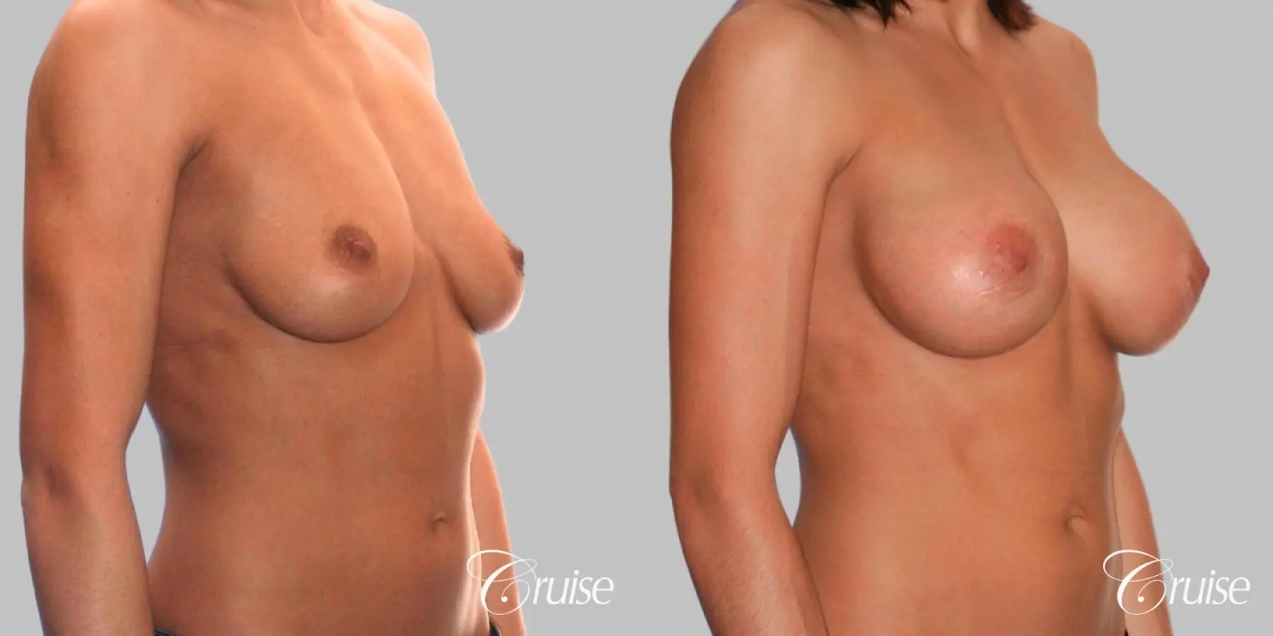 Breast Augmentation - Silicone HP 475cc - Before and After 2