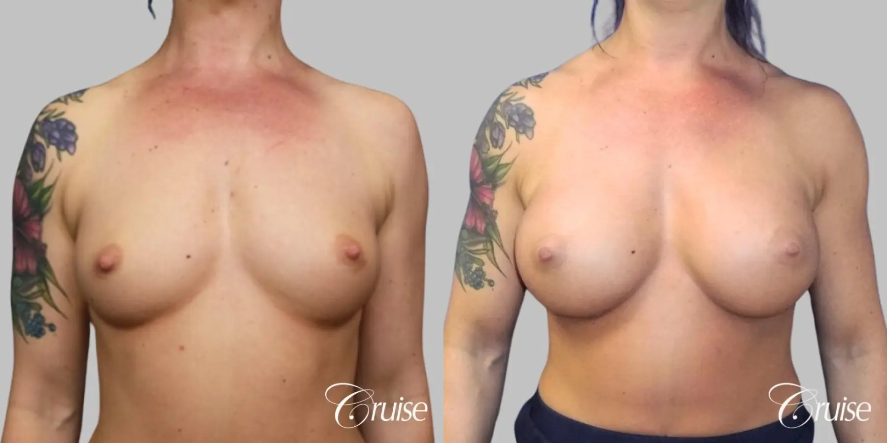 Breast Augmentation - Silicone HP 400cc - Before and After 1