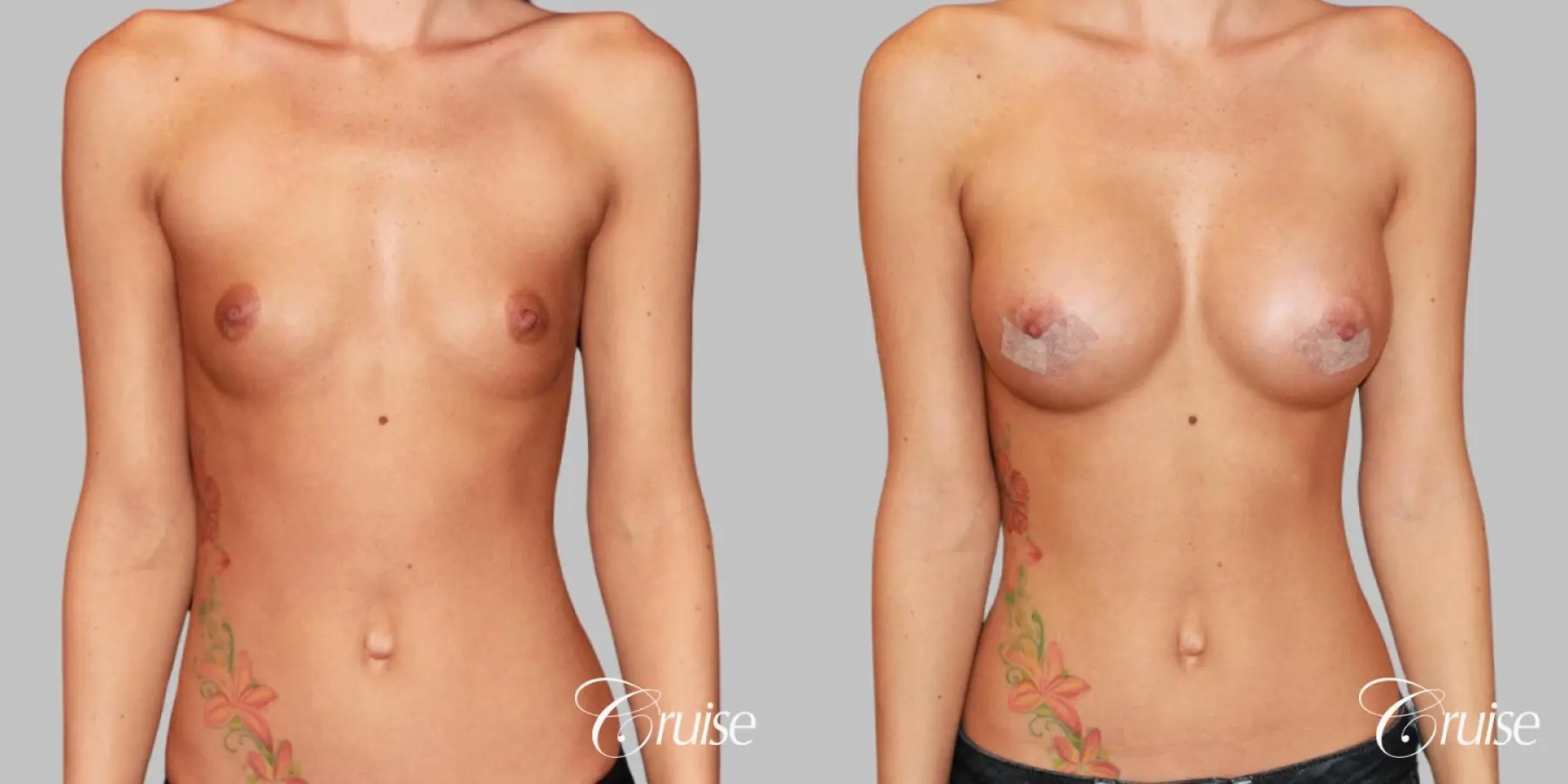 Breast Augmentation - Silicone MP 304cc - Before and After 1