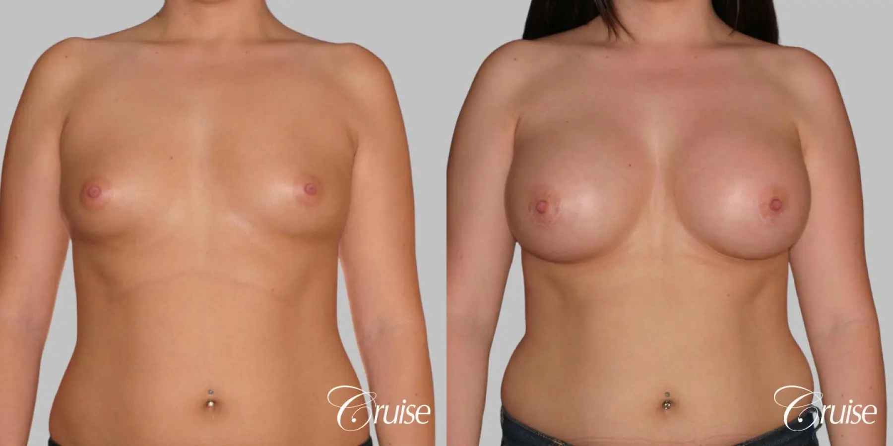 Breast Augmentation - Saline MP 375cc - Before and After 1