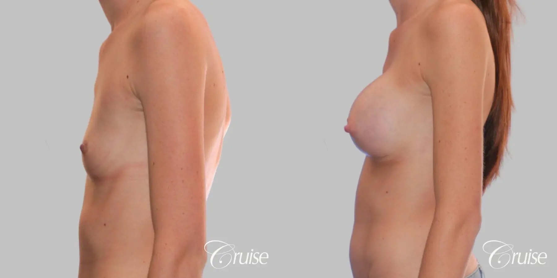 Breast Augmentation - Silicone MP 304cc - Before and After 3