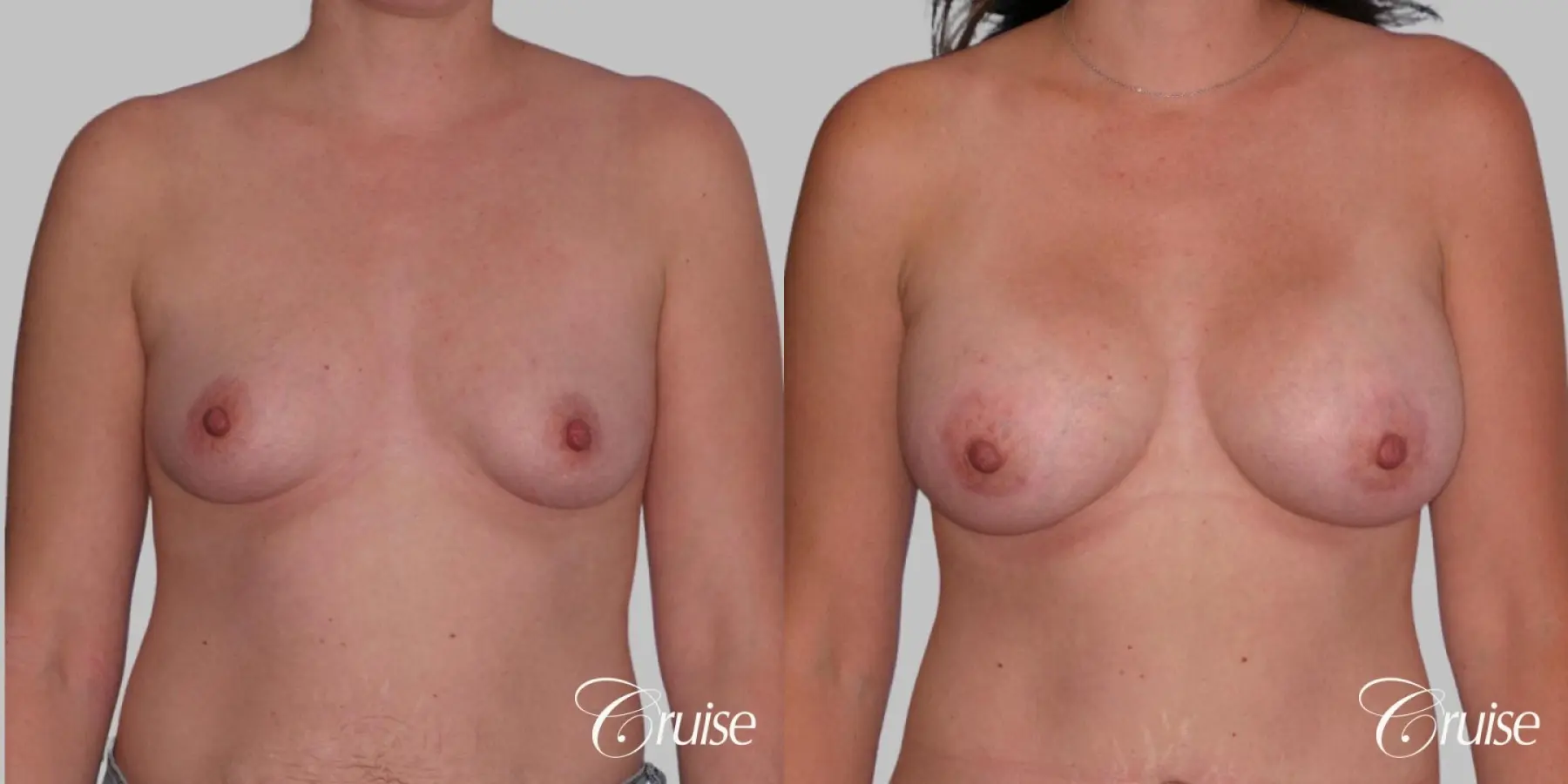 Breast Augmentation - Saline MP 360cc - Before and After 1