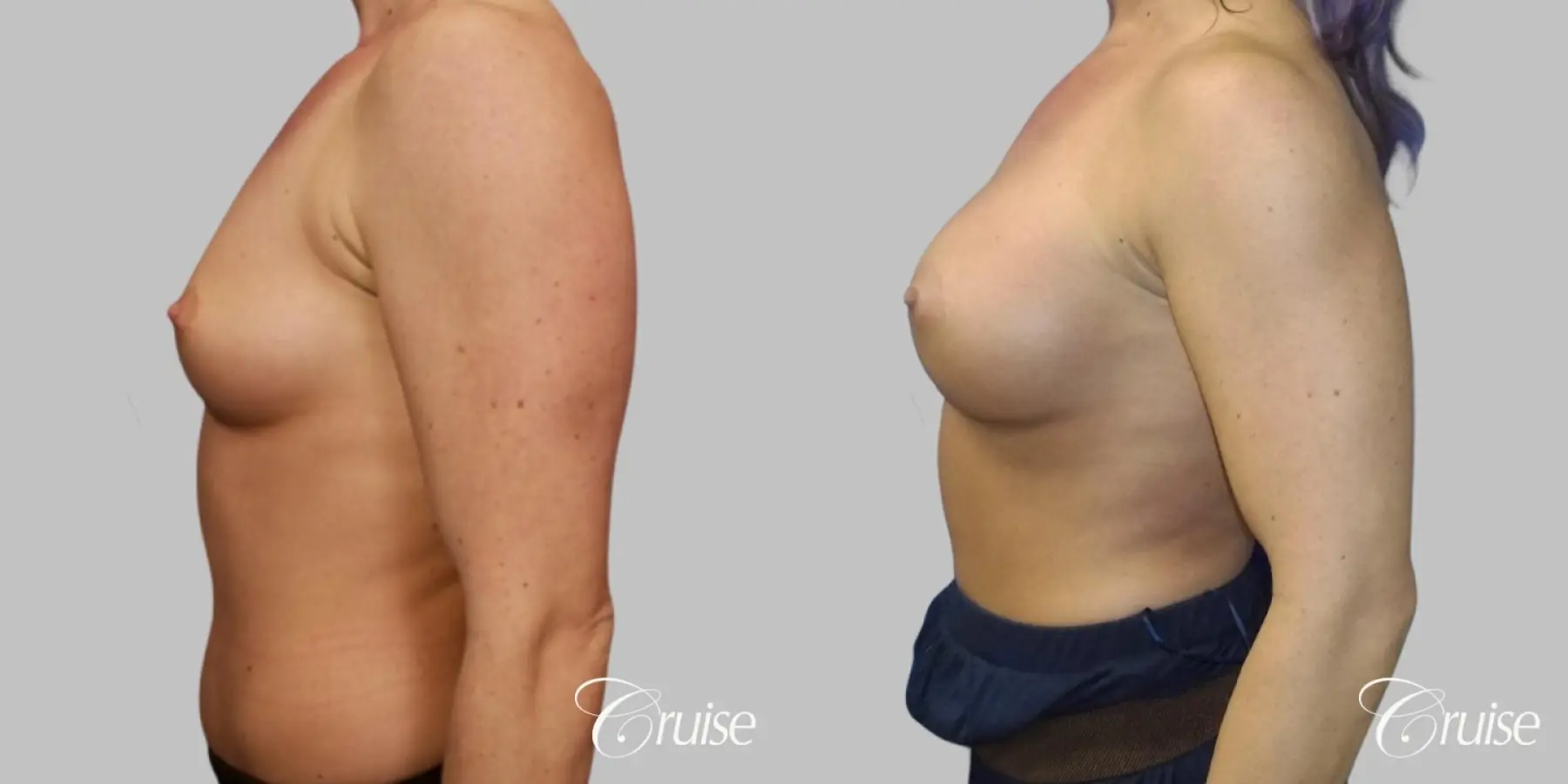 Breast Augmentation - Silicone HP 400cc - Before and After 3