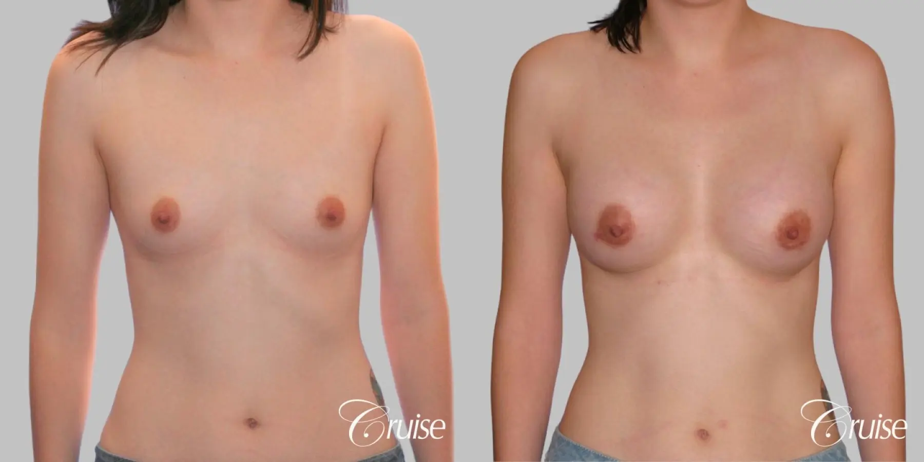 Breast Augmentation - Silicone MP 304cc - Before and After 1