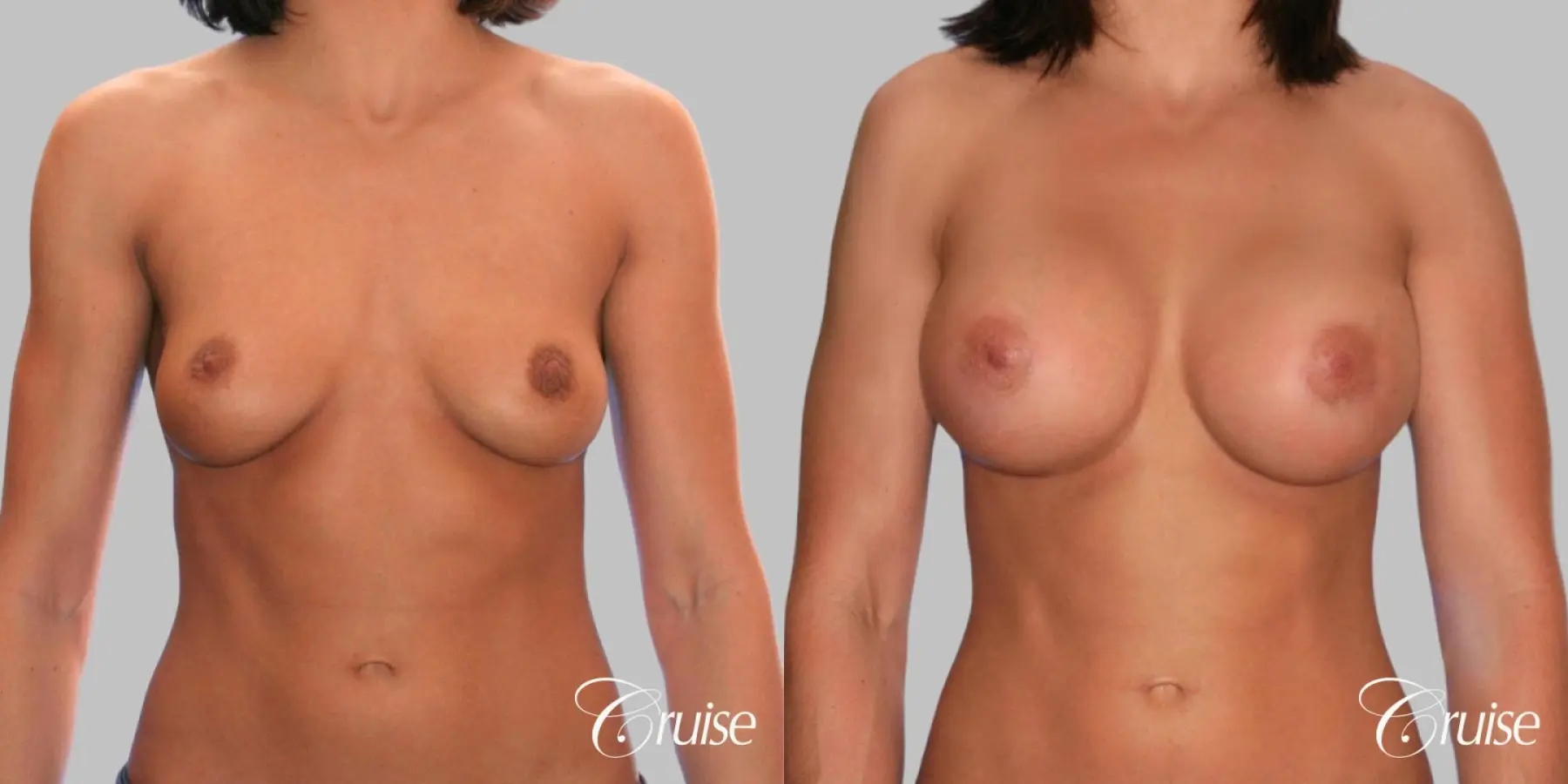 Breast Augmentation - Silicone HP 475cc - Before and After 1