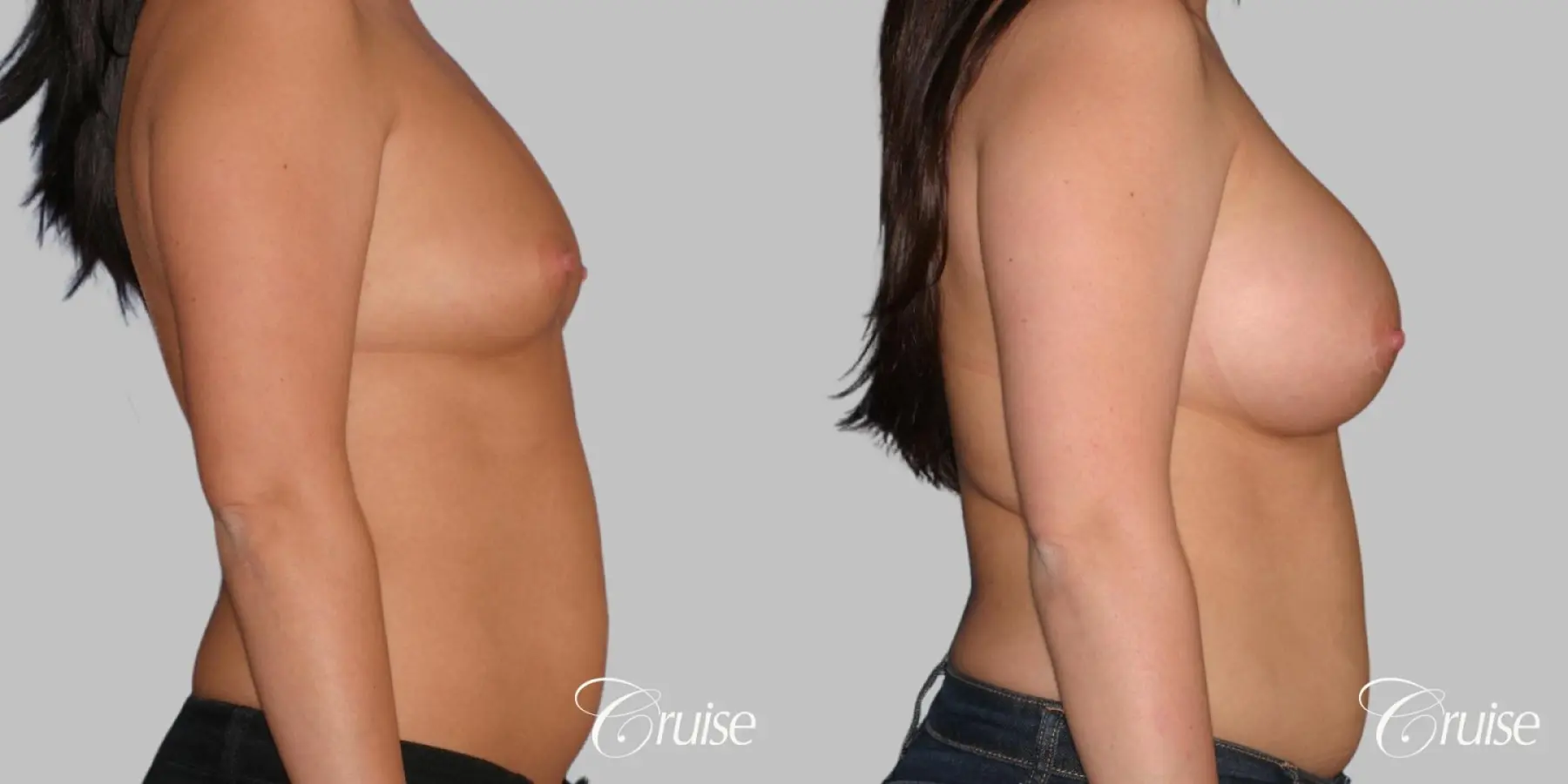 Breast Augmentation - Saline MP 375cc - Before and After 4