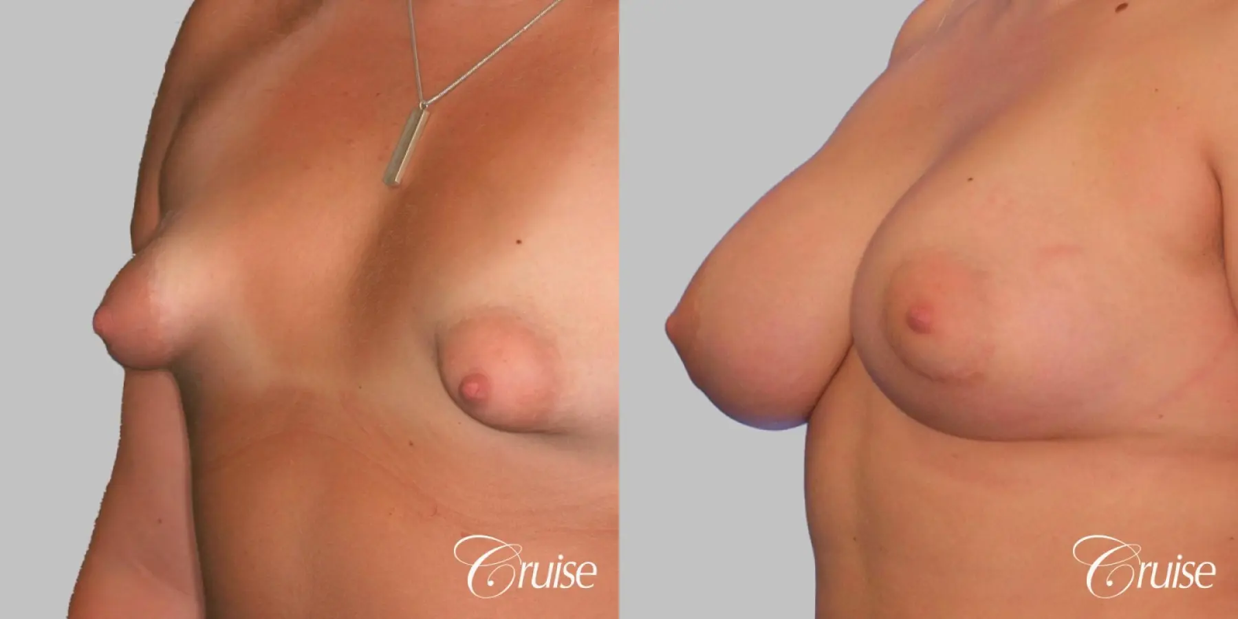 Breast Augmentation - Silicone HP 450cc - Before and After 3