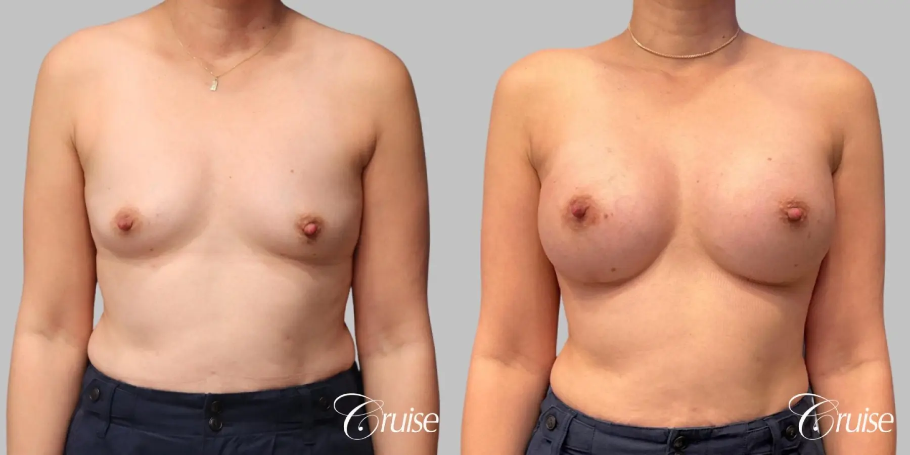 Breast Augmentation - Silicone 330cc  - Before and After 1