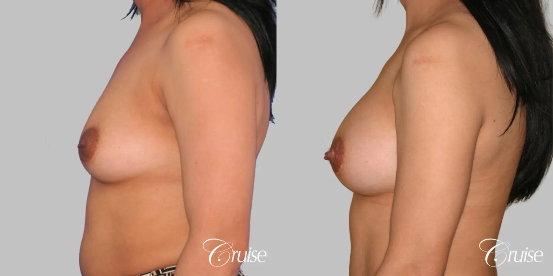 Breast Augmentation - Saline LP 245cc - Before and After 2