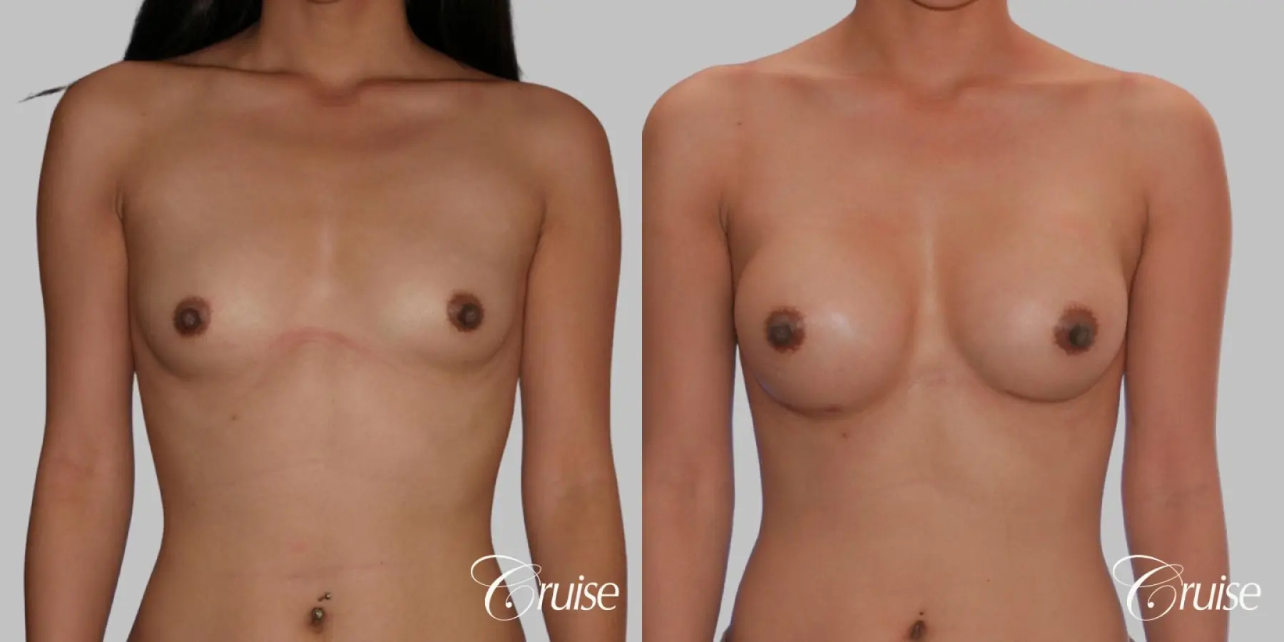 Breast Augmentation - Silicone HP 325cc - Before and After  