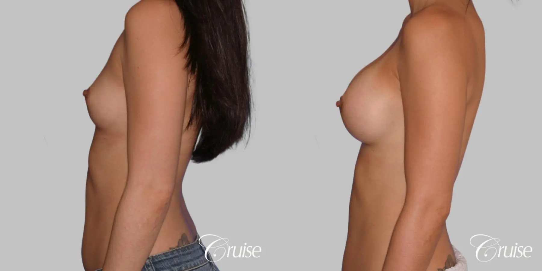 Breast Augmentation - Saline HP 280cc - Before and After 2