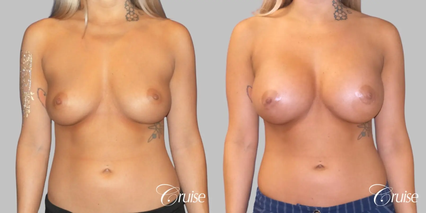 Breast Augmentation - Silicone HP 475cc - Before and After  