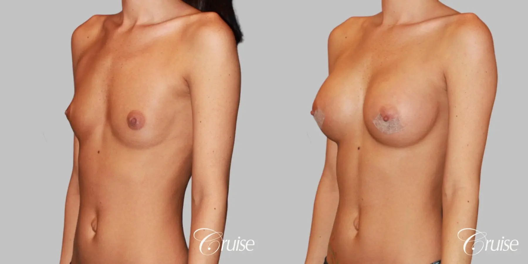 Breast Augmentation - Silicone MP 304cc - Before and After 2