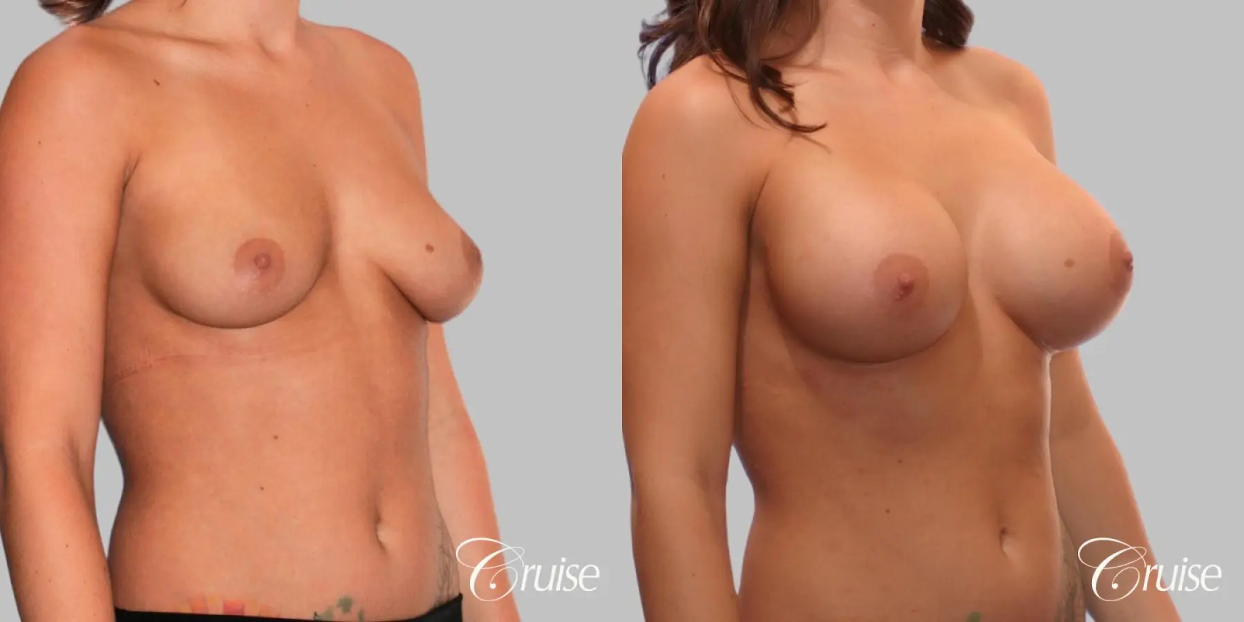 Breast Augmentation - Silicone HP 475cc - Before and After 2