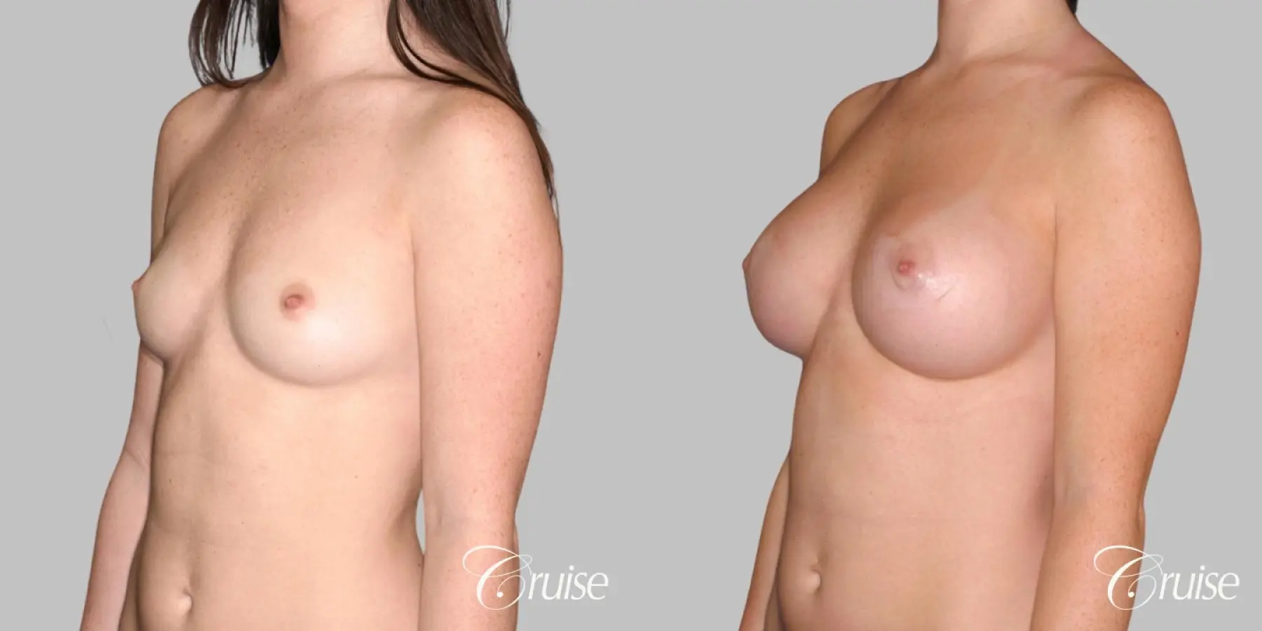 Breast Augmentation - Silicone HP 400cc - Before and After 2