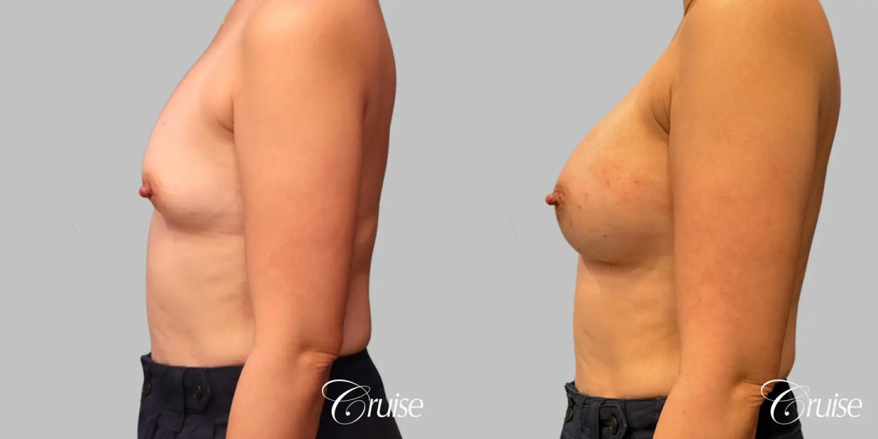 Breast Augmentation - Silicone 330cc  - Before and After 4