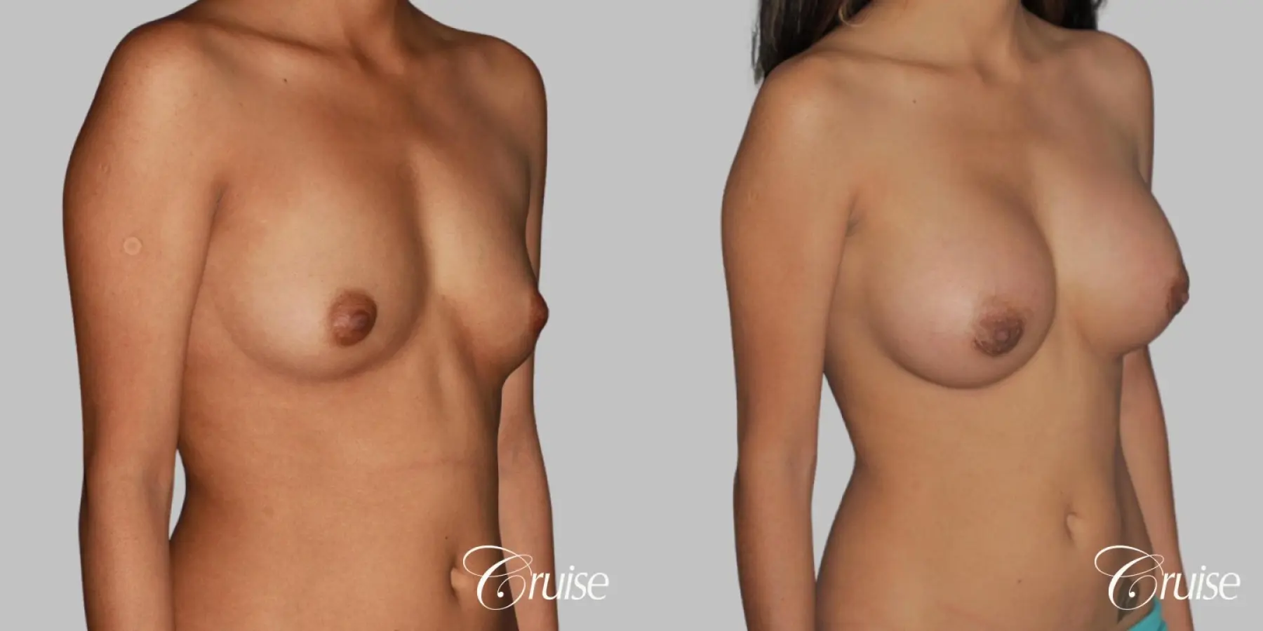 Breast Augmentation - Silicone MP 339cc - Before and After 3