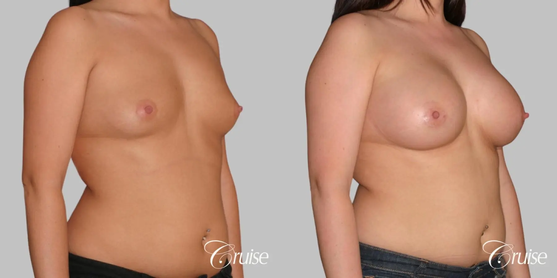 Breast Augmentation - Saline MP 375cc - Before and After 3