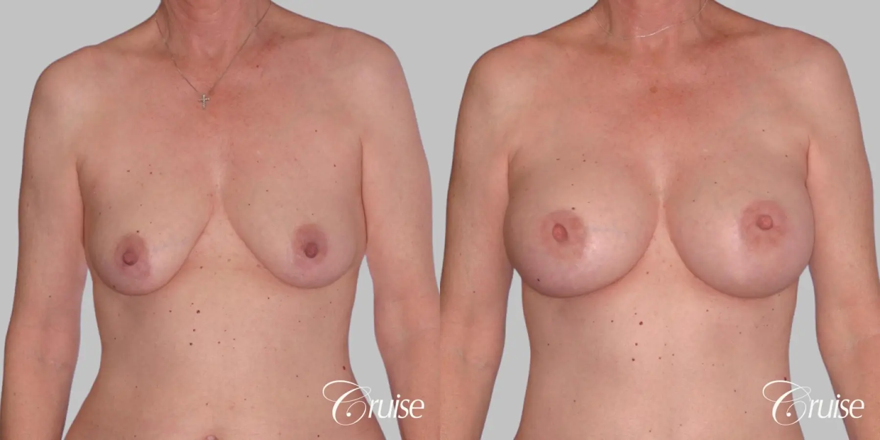 Breast Augmentation - Saline HP 450cc - Before and After 1