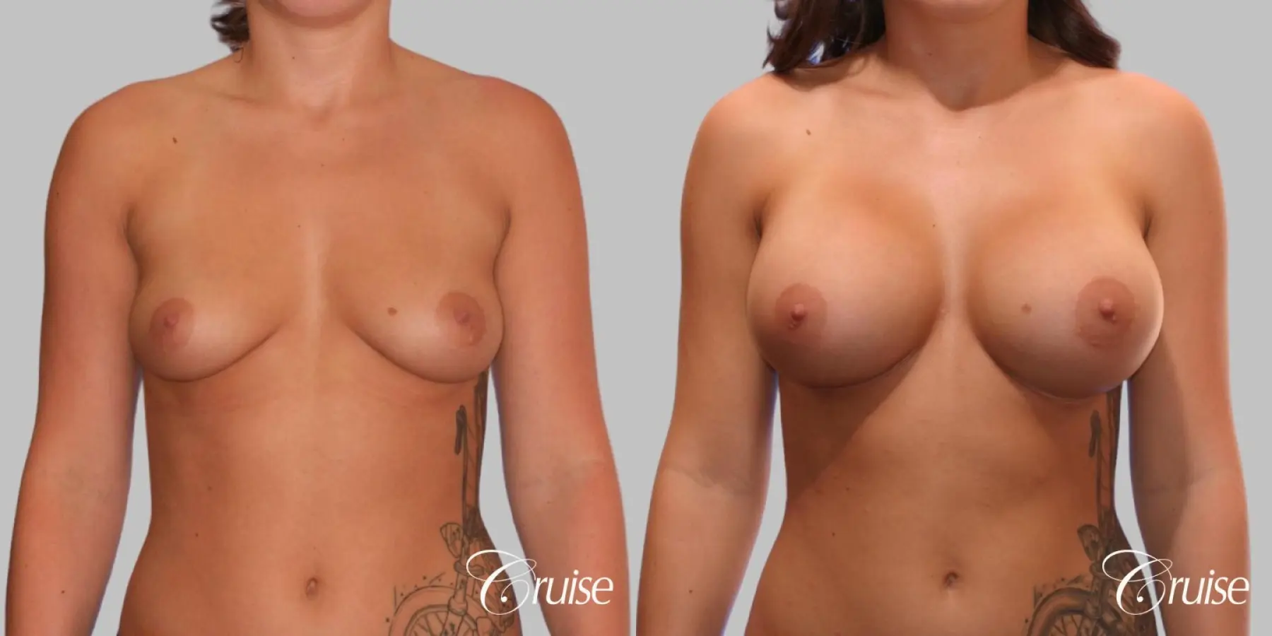 Breast Augmentation - Silicone HP 475cc - Before and After  