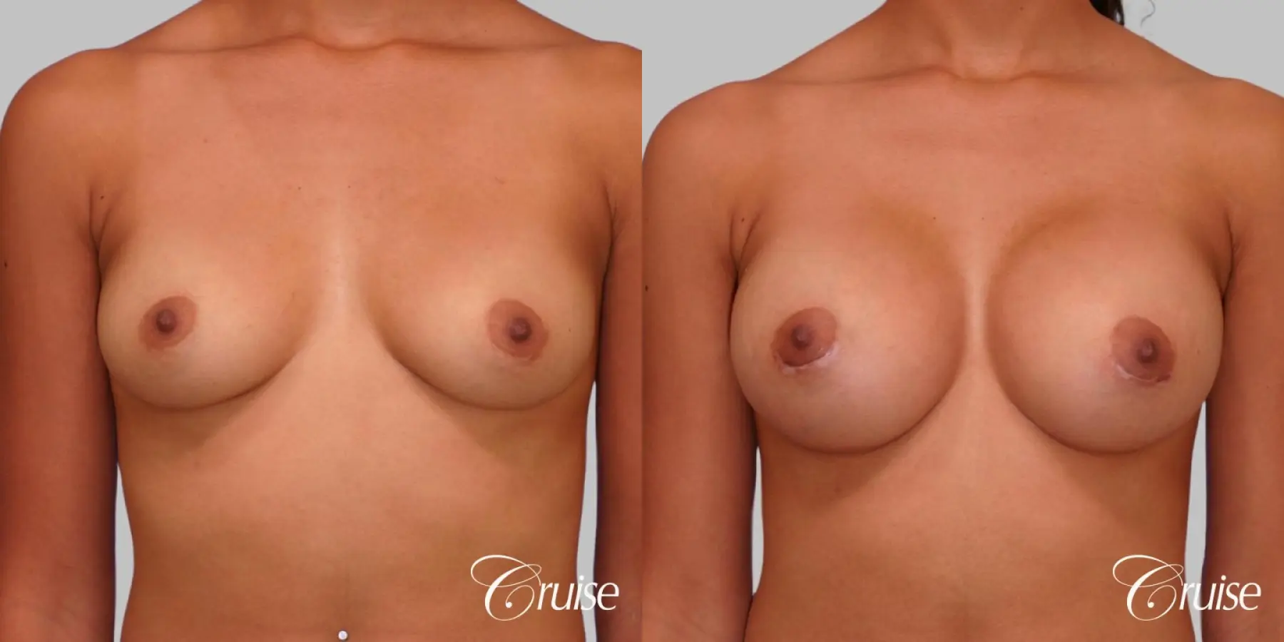 Breast Augmentation - Saline MP 375cc - Before and After  