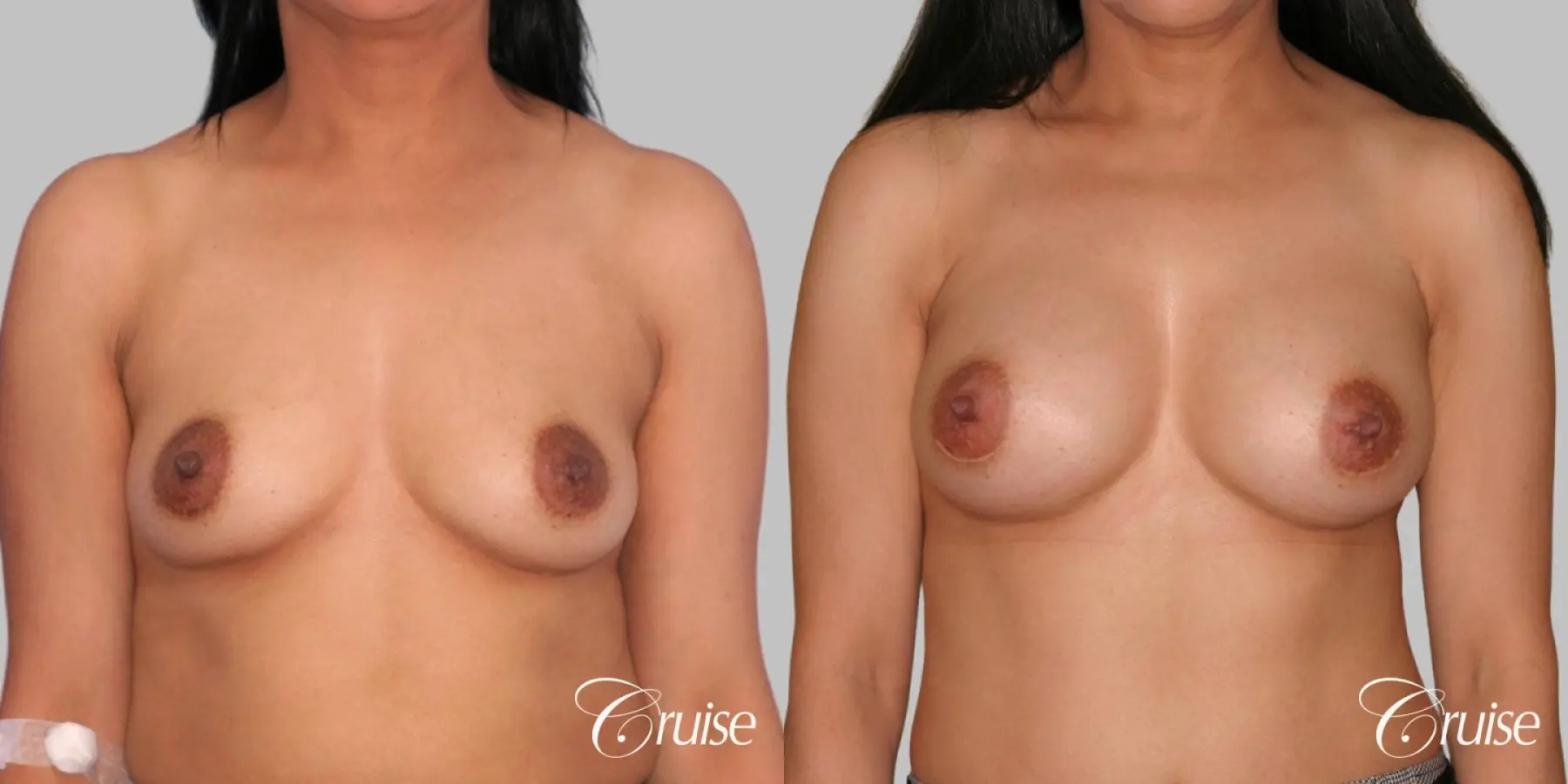 Breast Augmentation - Saline LP 245cc - Before and After 1