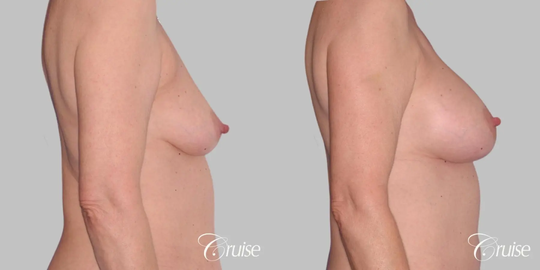 Breast Augmentation - Saline HP 450cc - Before and After 3