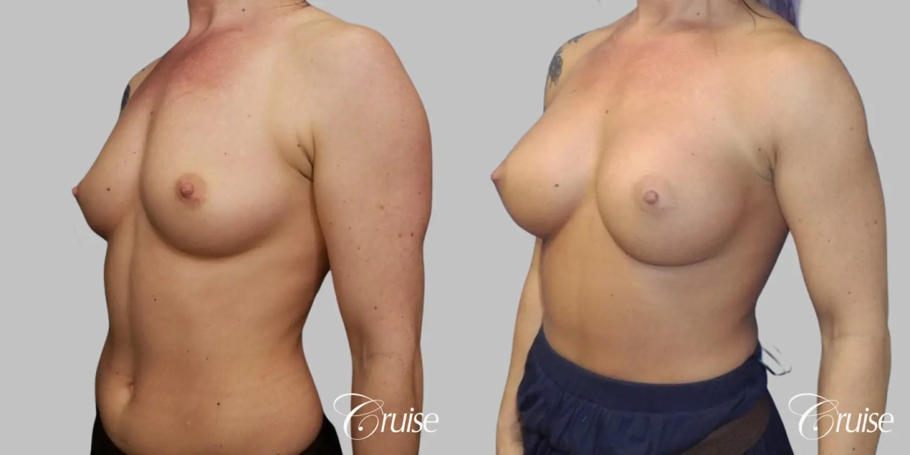 Breast Augmentation - Silicone HP 400cc - Before and After 2