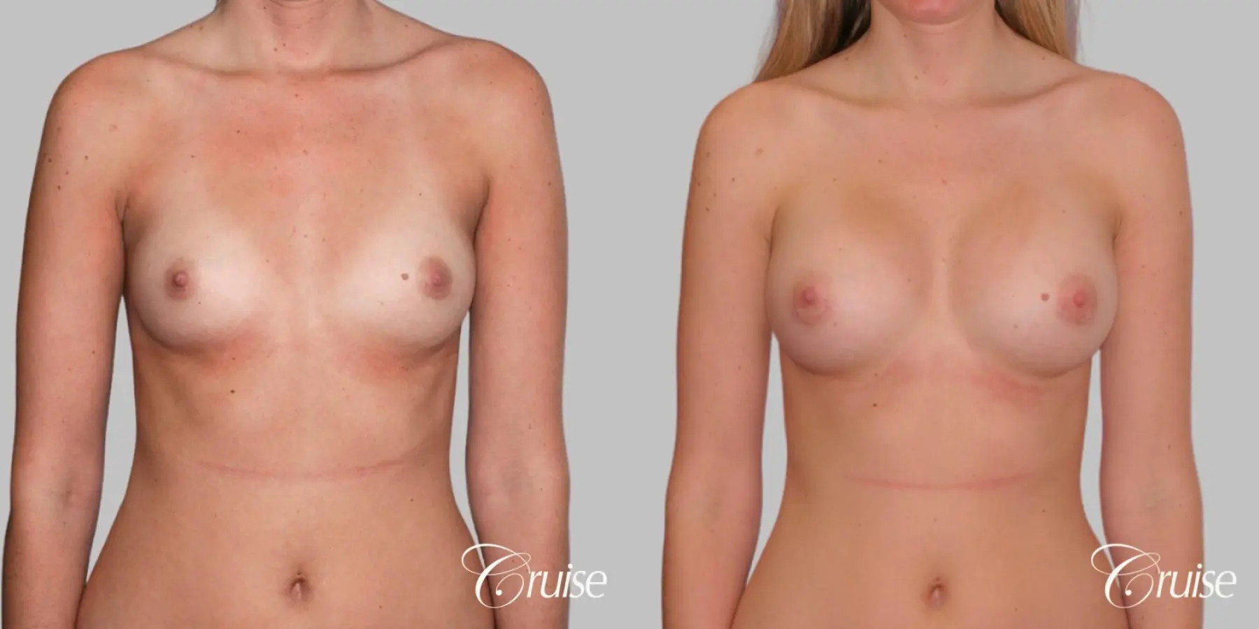 Breast Augmentation - Saline MP 440cc - Before and After 1