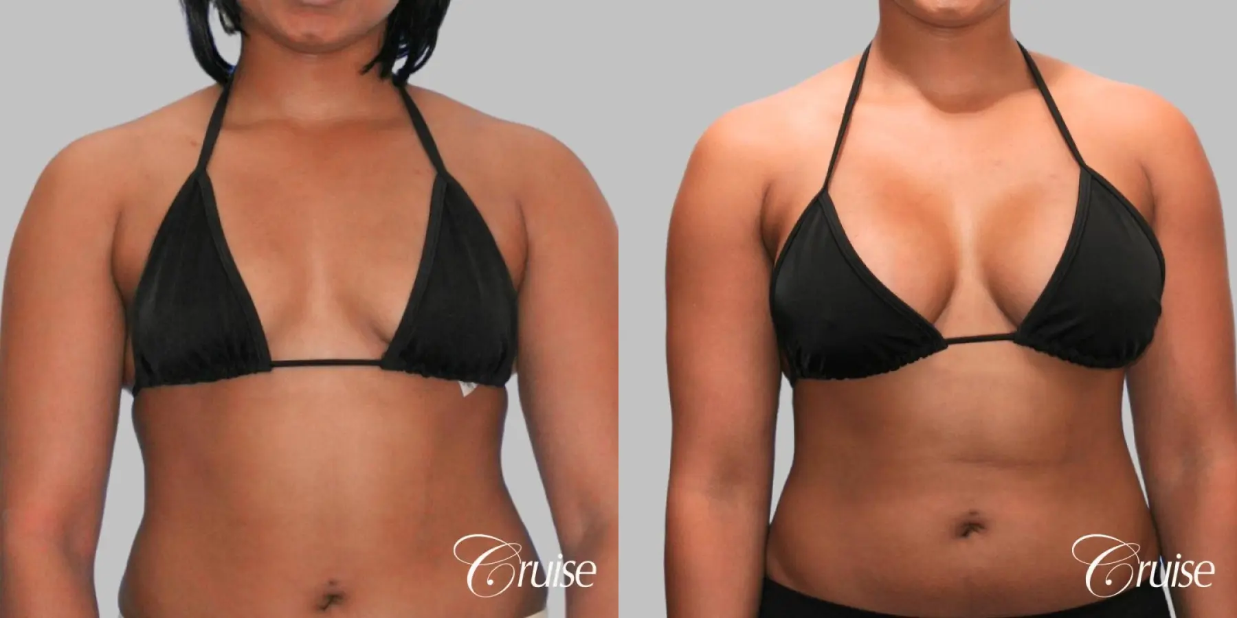 Breast Augmentation - Silicone HP 450cc - Before and After 4