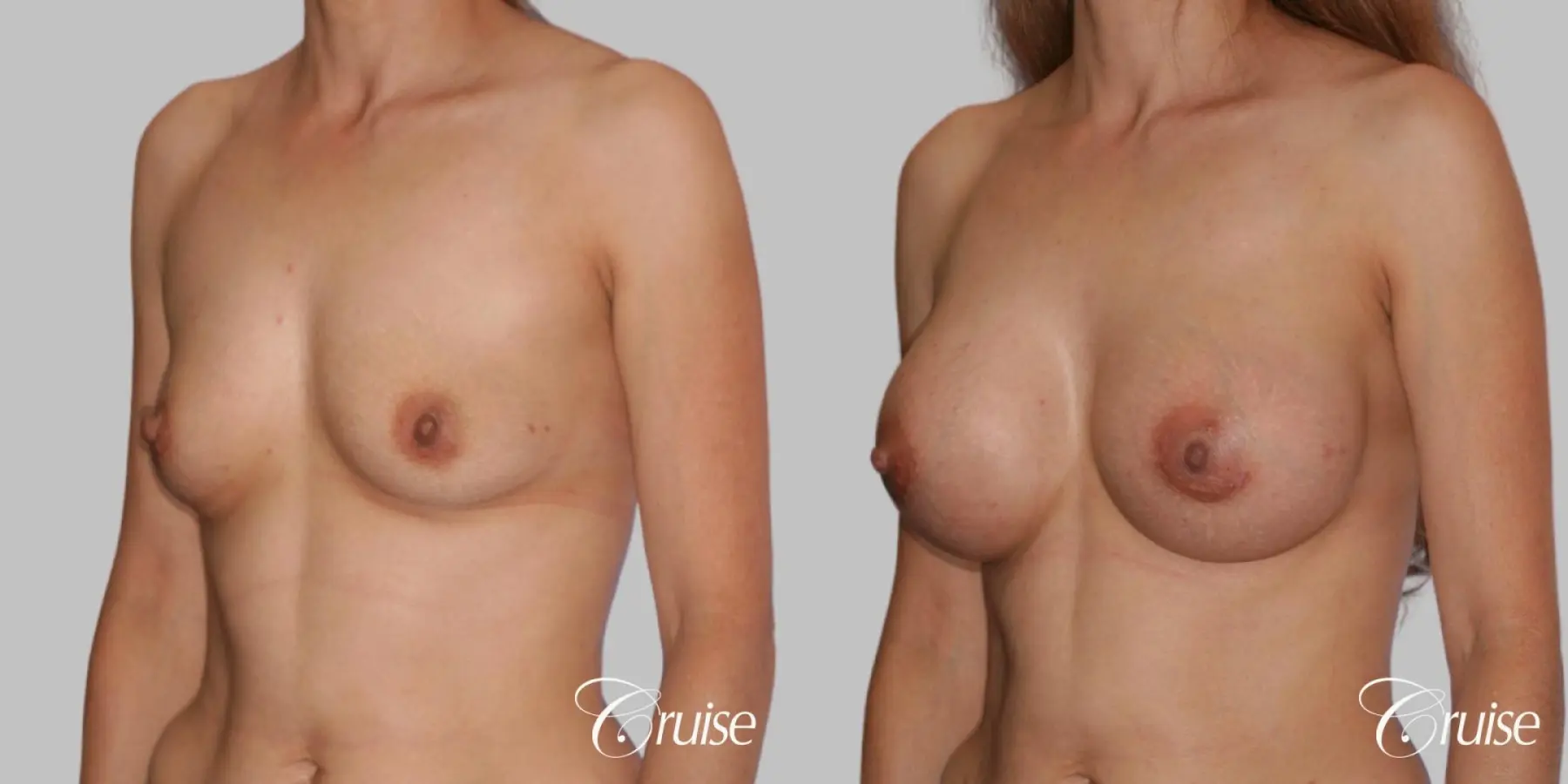 Breast Augmentation - Silicone HP 325cc - Before and After 2