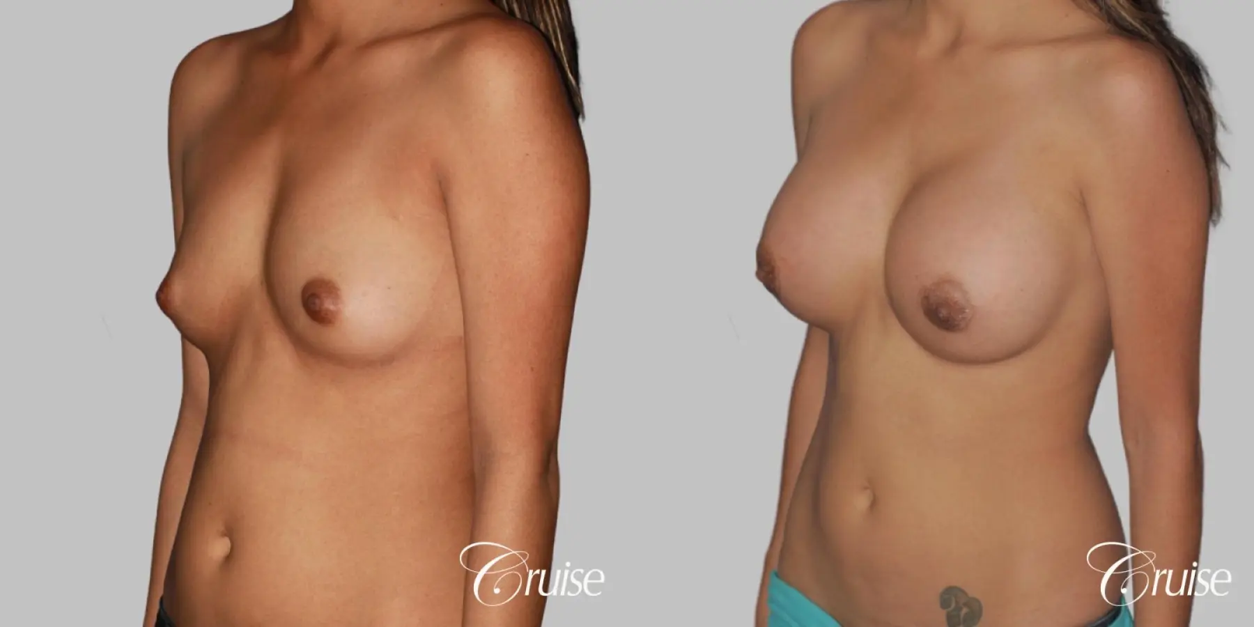 Breast Augmentation - Silicone MP 339cc - Before and After 2