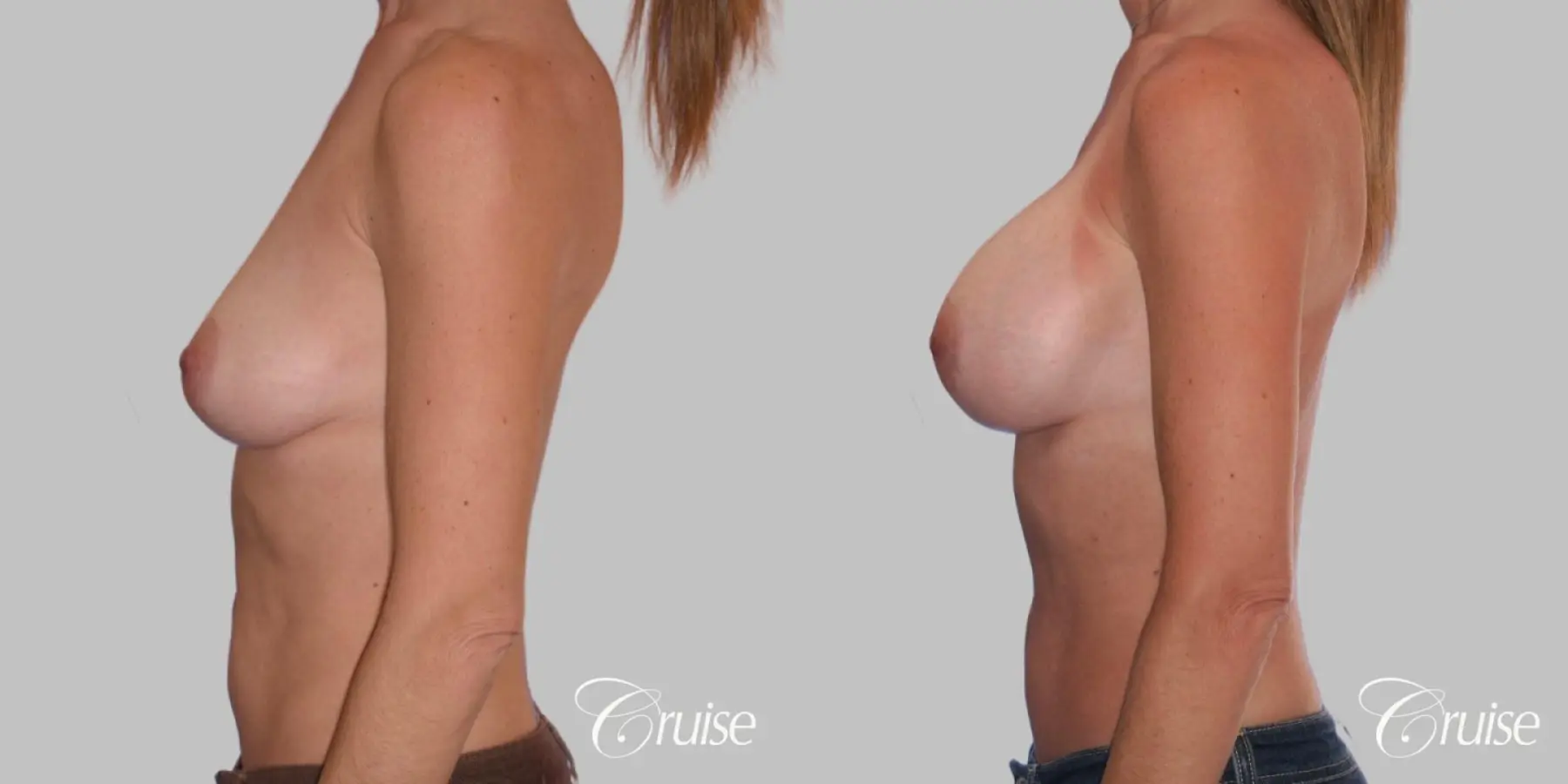 Breast Augmentation - Silicone MP 320cc - Before and After 3