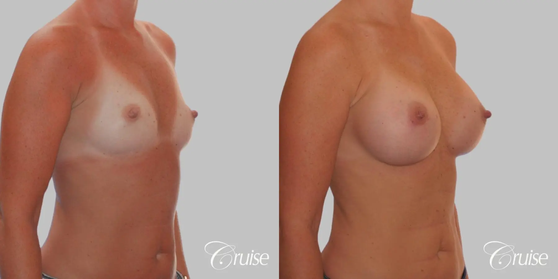 Breast Augmentation - Saline HP 370cc - Before and After 2