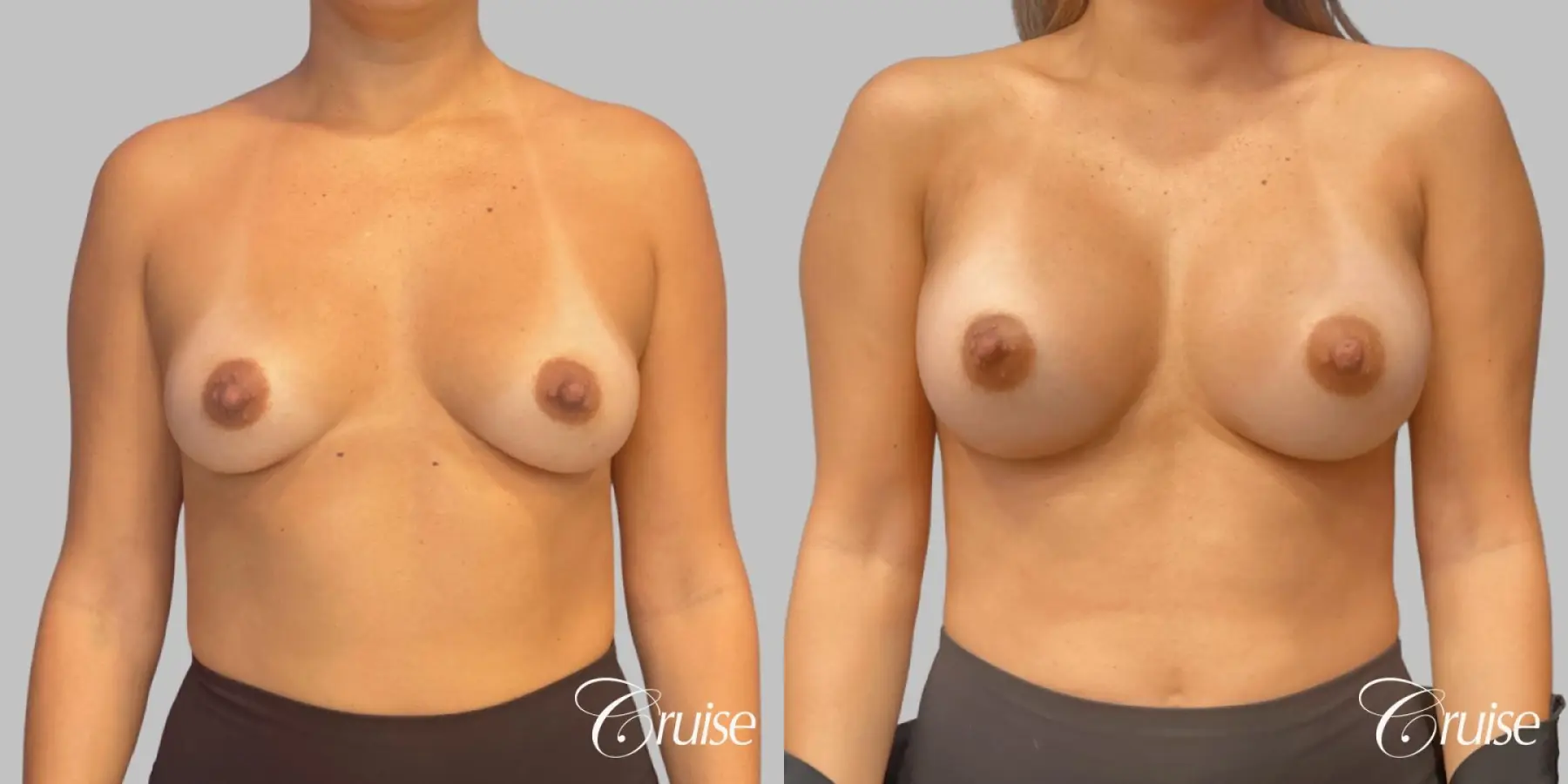 Breast Augmentation - Silicone SRM 375cc - Before and After  