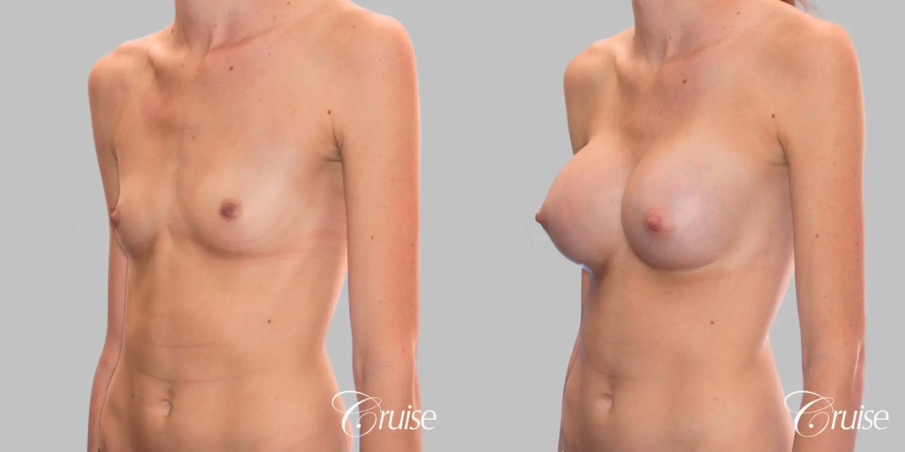 Breast Augmentation - Silicone MP 304cc - Before and After 2