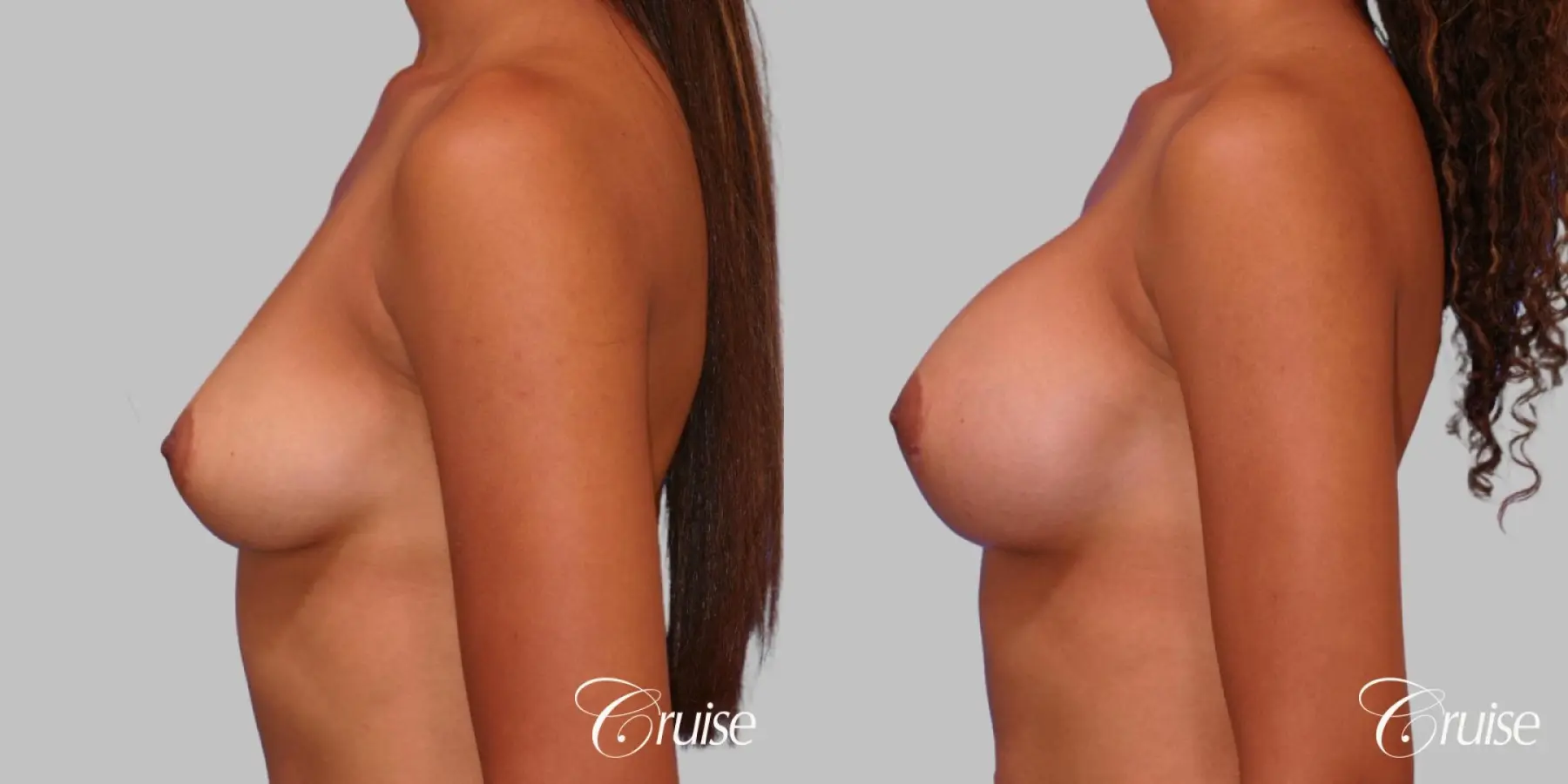 Breast Augmentation - Saline MP 375cc - Before and After 2