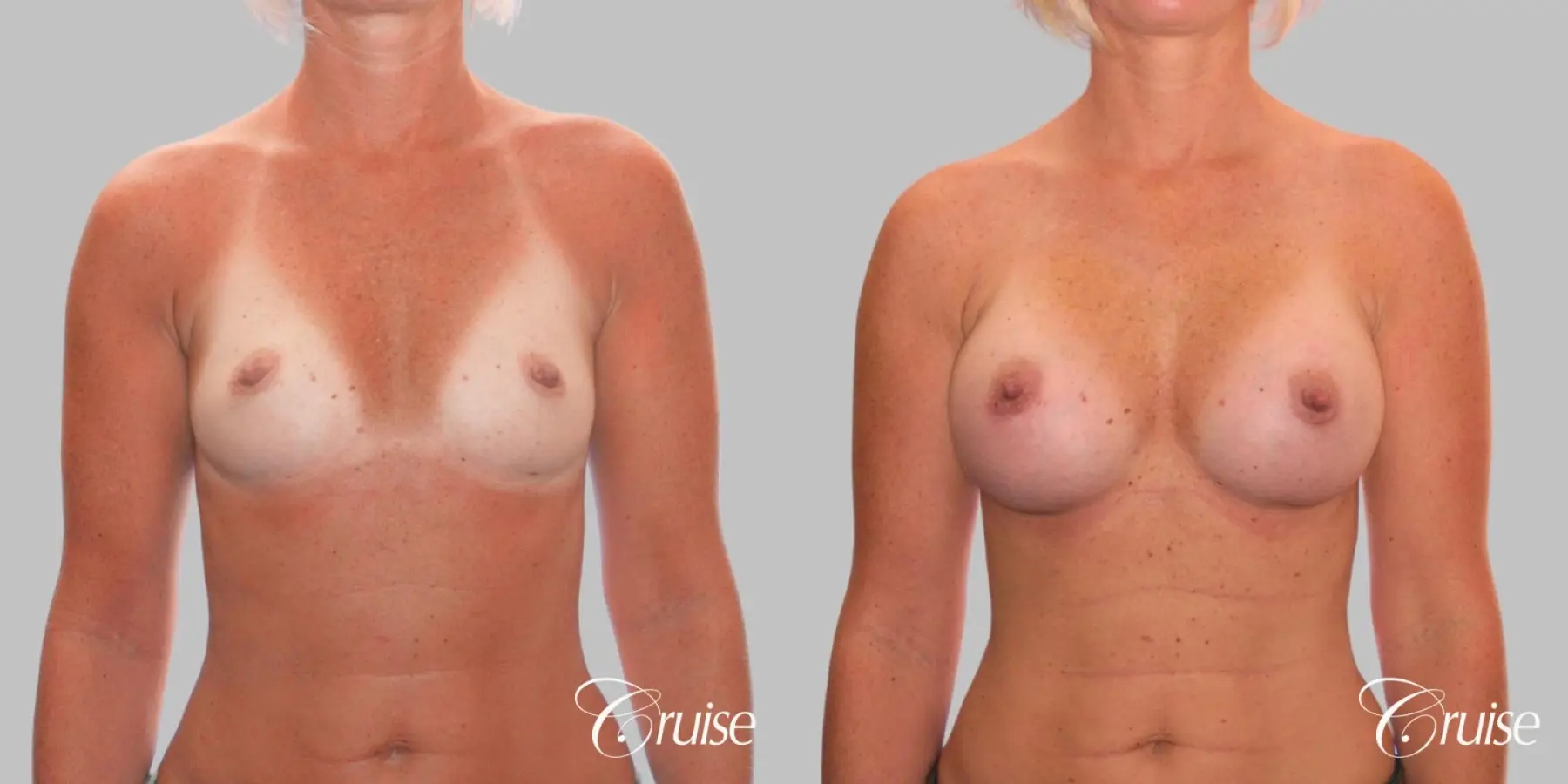 Breast Augmentation - Saline HP 370cc - Before and After  