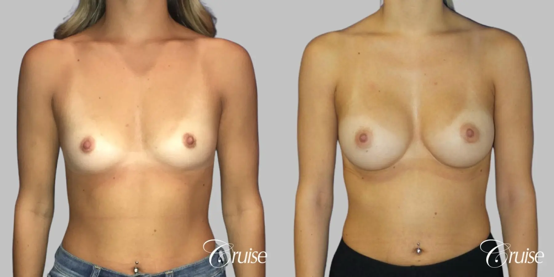 Breast Augmentation - Silicone MP 325cc - Before and After  