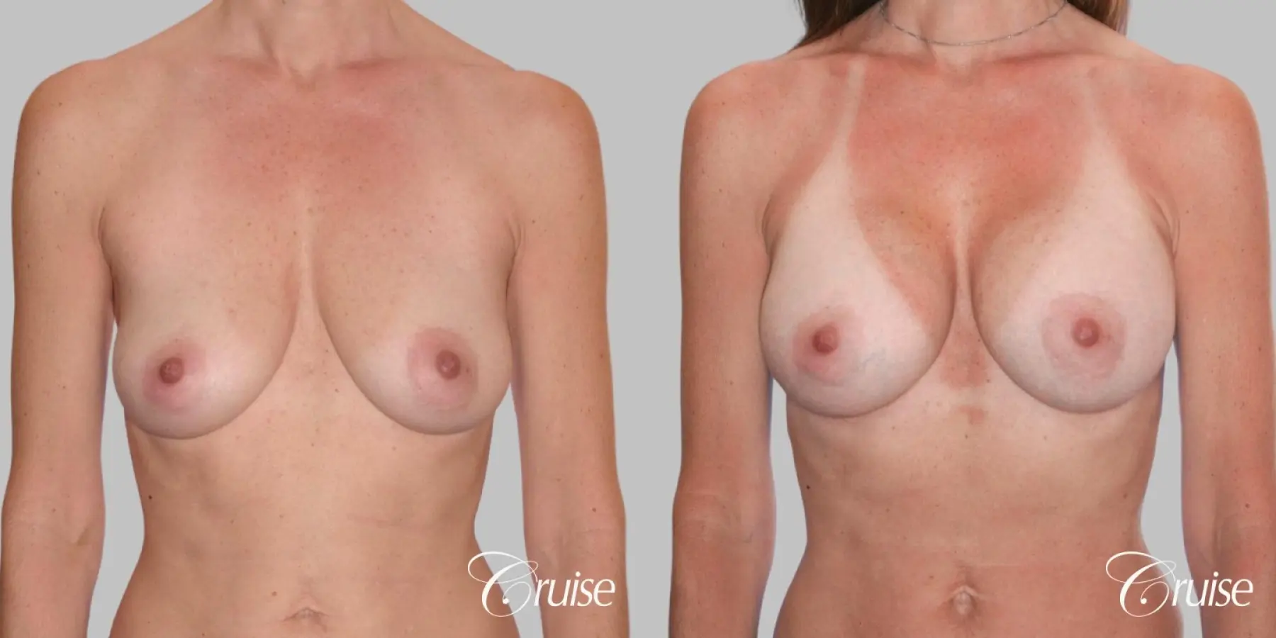 Breast Augmentation - Silicone MP 320cc - Before and After 1