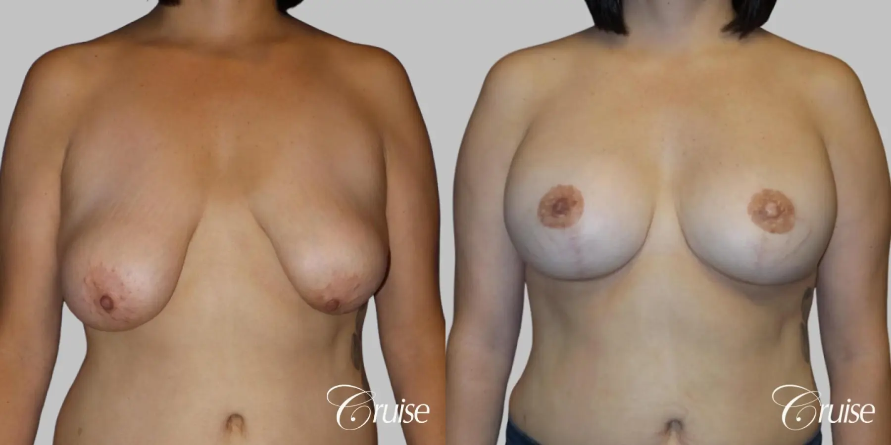 Breast Lift - Anchor with Saline Augmentation - Before and After 1